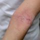 Armbeuge mit Neurodermitis